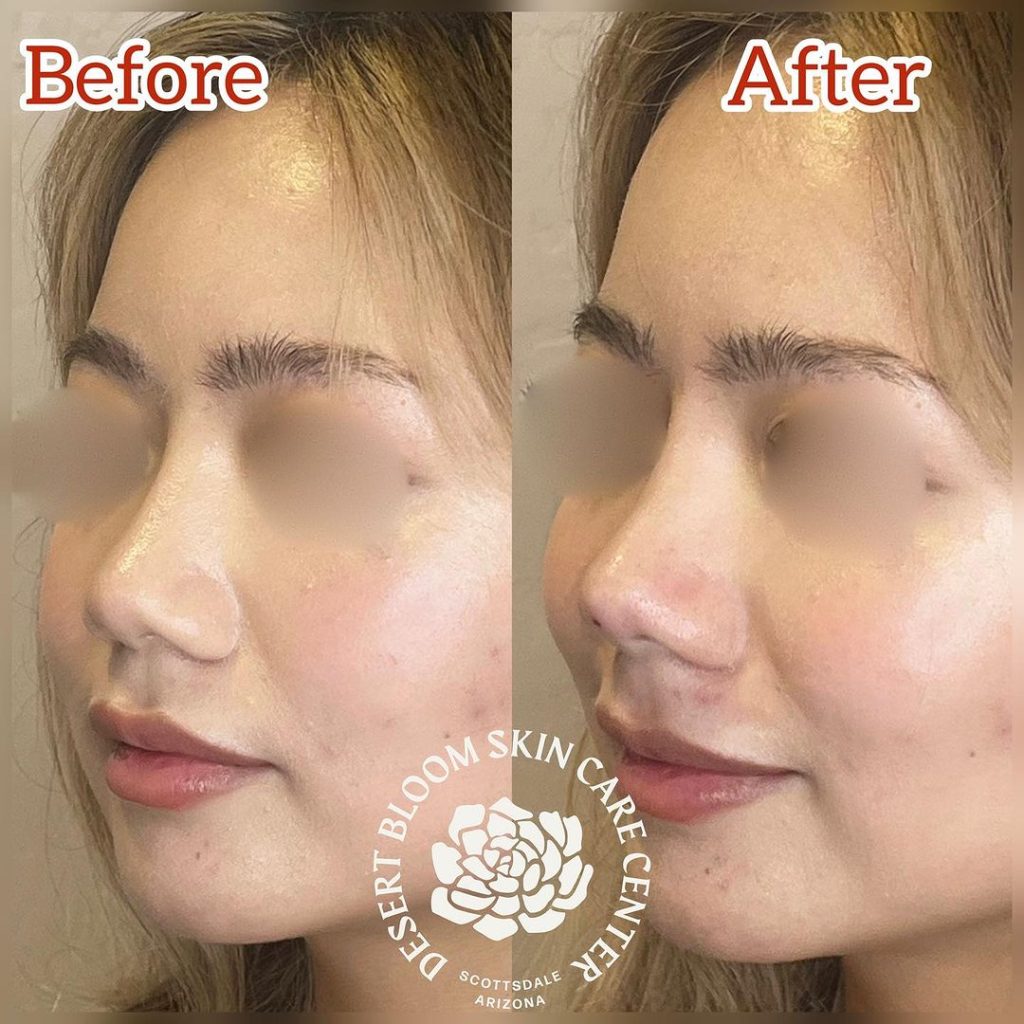 before & after | Non surgical rhinoplasty with PDO threads | profile 3-4 left