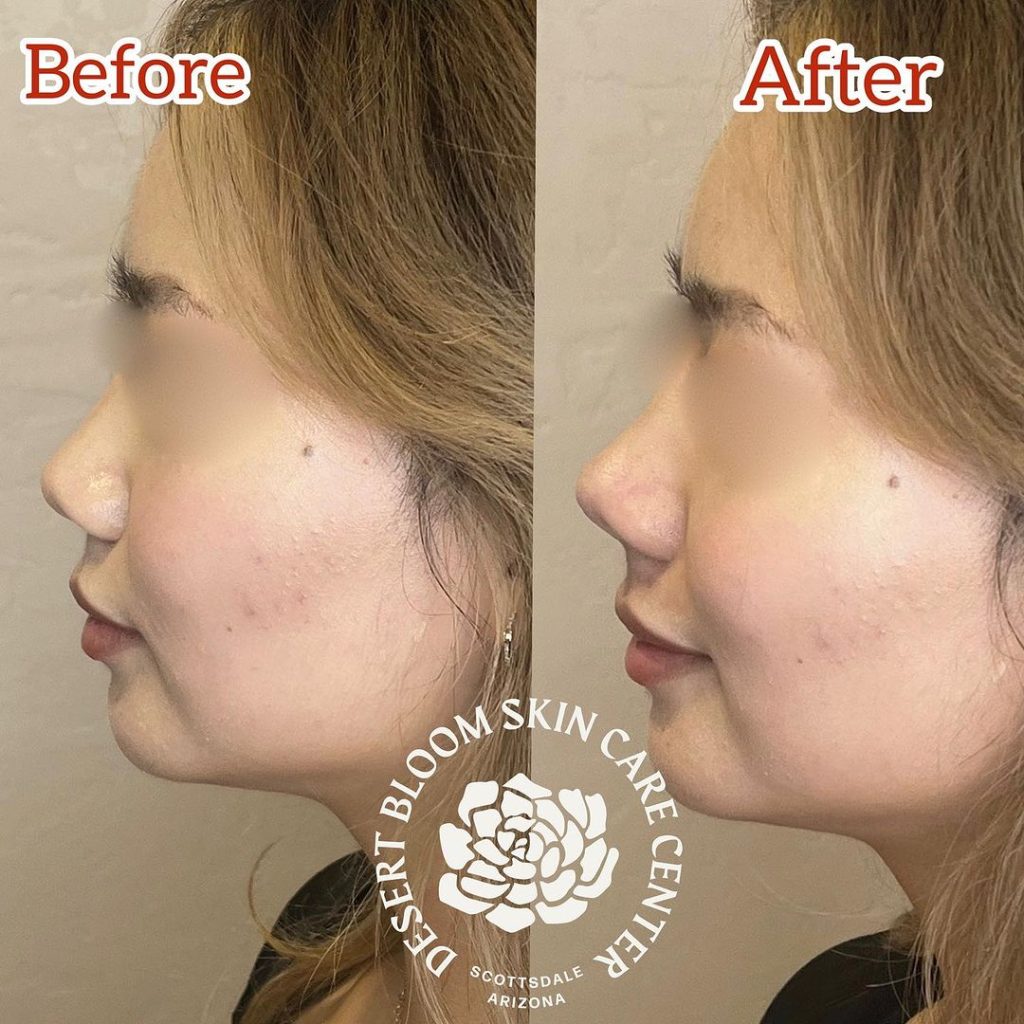 before & after | Non surgical rhinoplasty with PDO threads | profile left