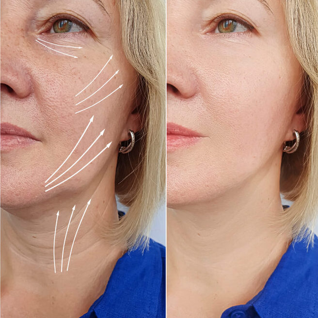 Facelift PDO before and after