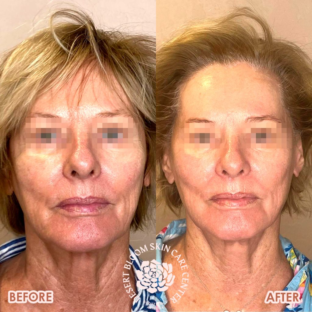 before & after | PDO-thread-lift | mid-face | full face