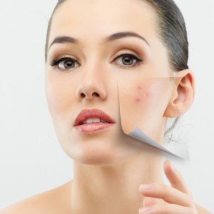 acne-image