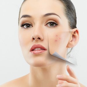 acne-image acne-image