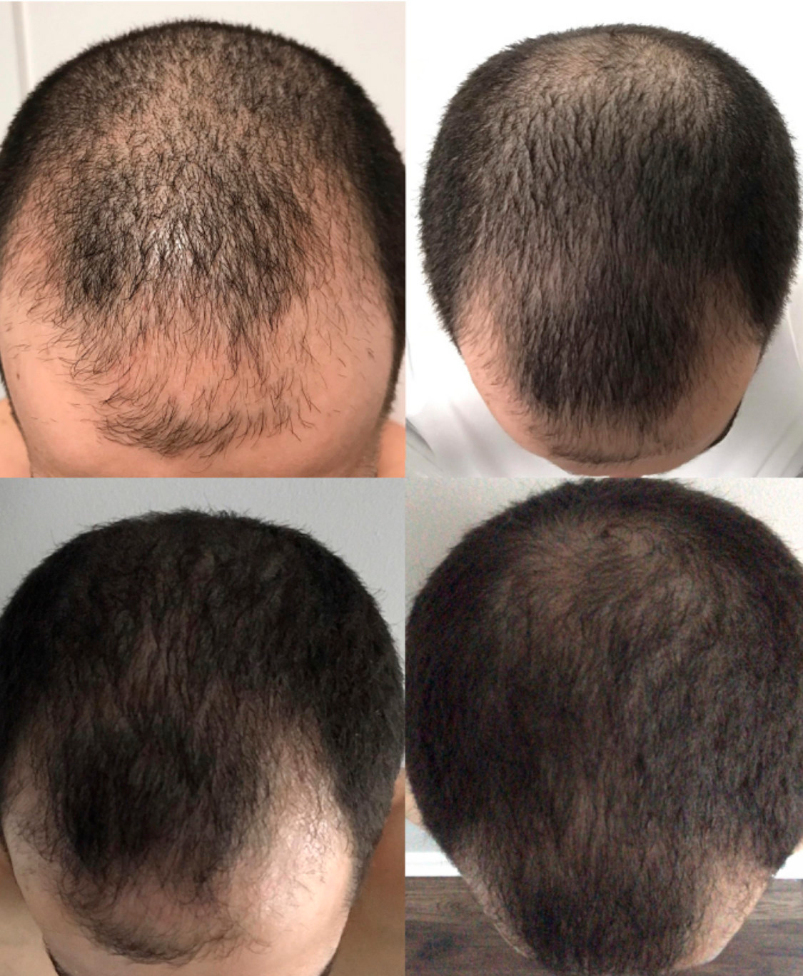 Before and after of hair rejuvenation in Scottsdale, AZ