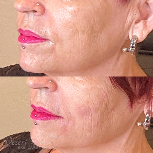 thread face lift