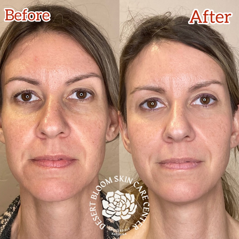 before & after fattransfer