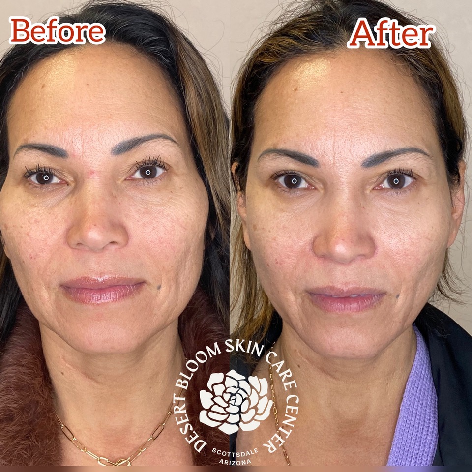 before & after fattransfer
