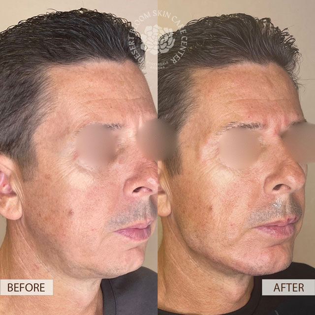 PDO-Thread Lift before after men