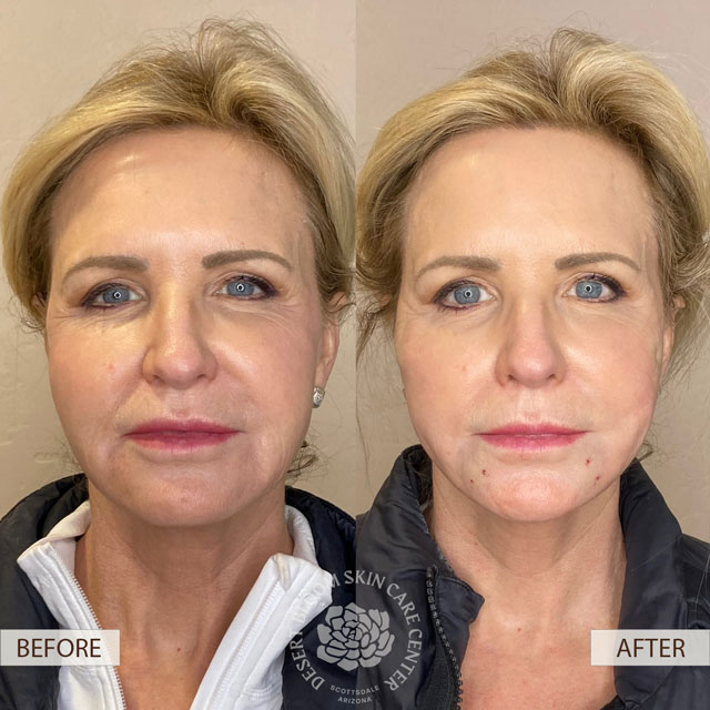 PDO Thread Lift before after