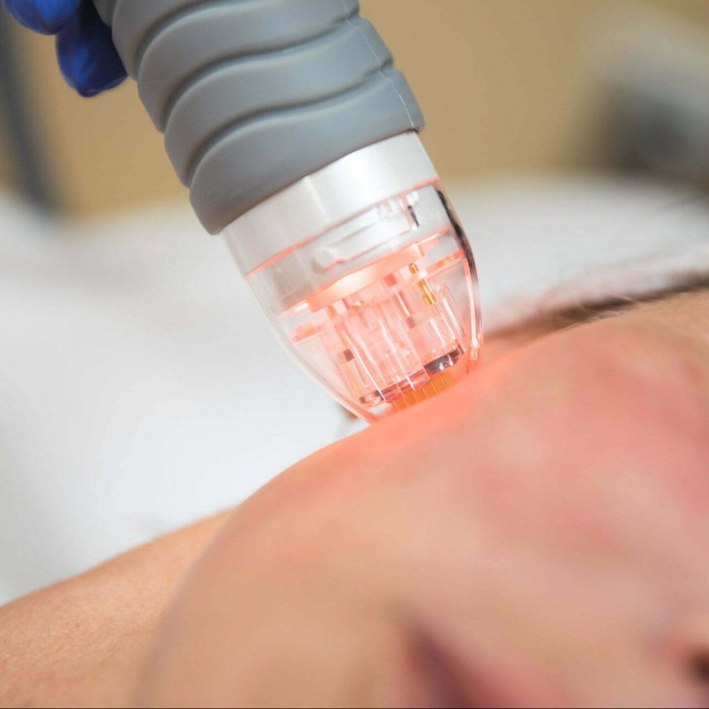 RF Microneedling in Scottsdale
