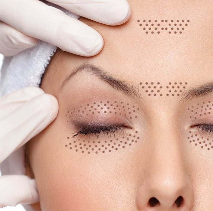 Plasma Pen | Your Ultimate Guide - DesertBloom skincare