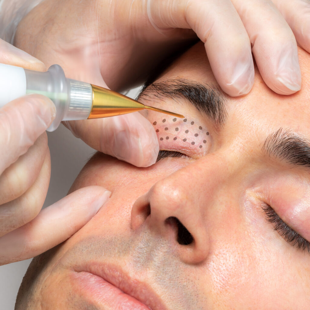 plasma pen therapy on eyelids