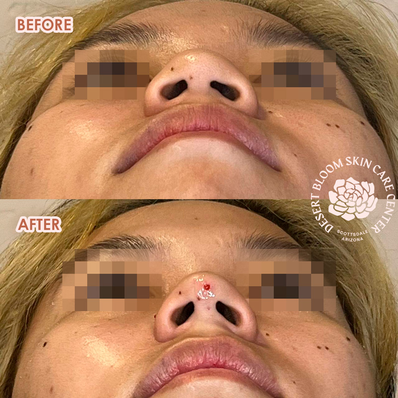 Tip projection for Asian noses Photo