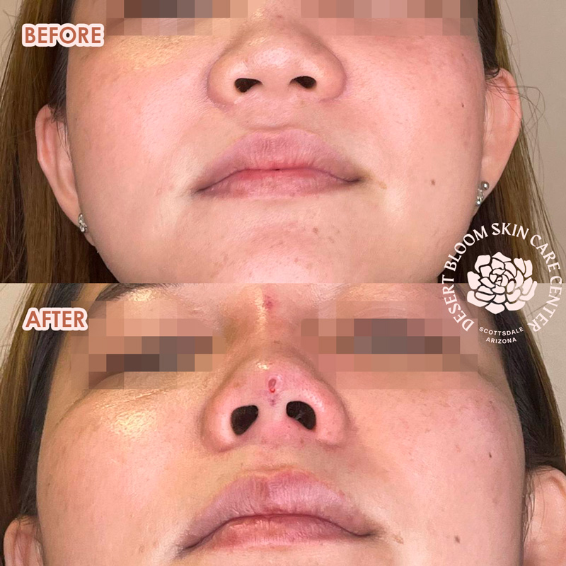 Tip projection for Asian noses Photo