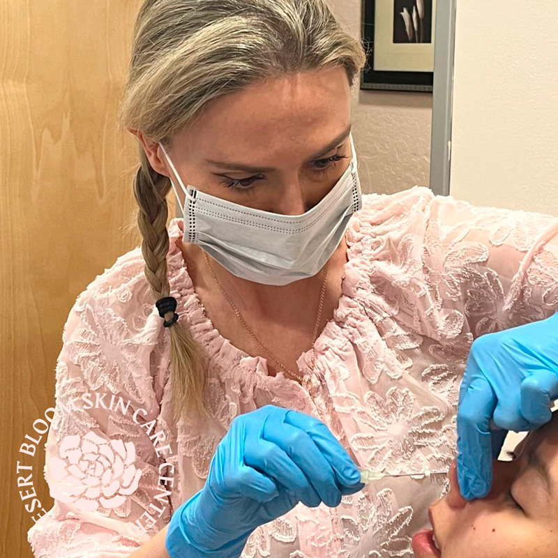 Non surgical nose correction with PDO threads