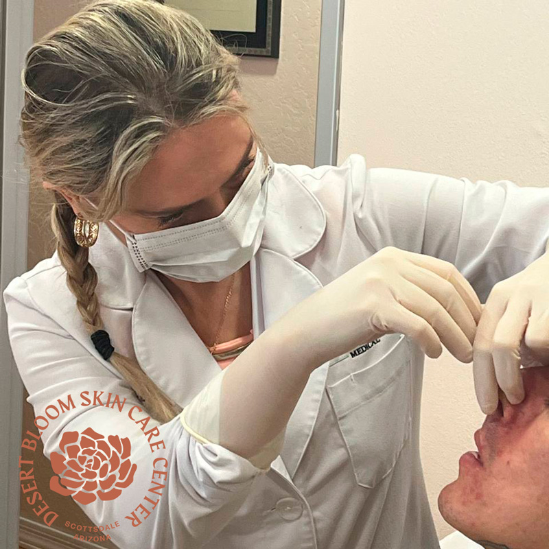 Non surgical nose correction with PDO threads