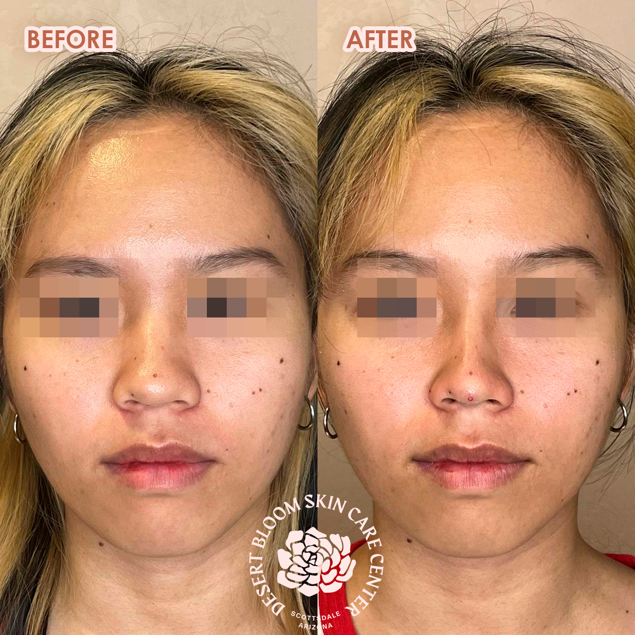 Building bridge and projection in Asian nose | Before & After | Front Face Photo