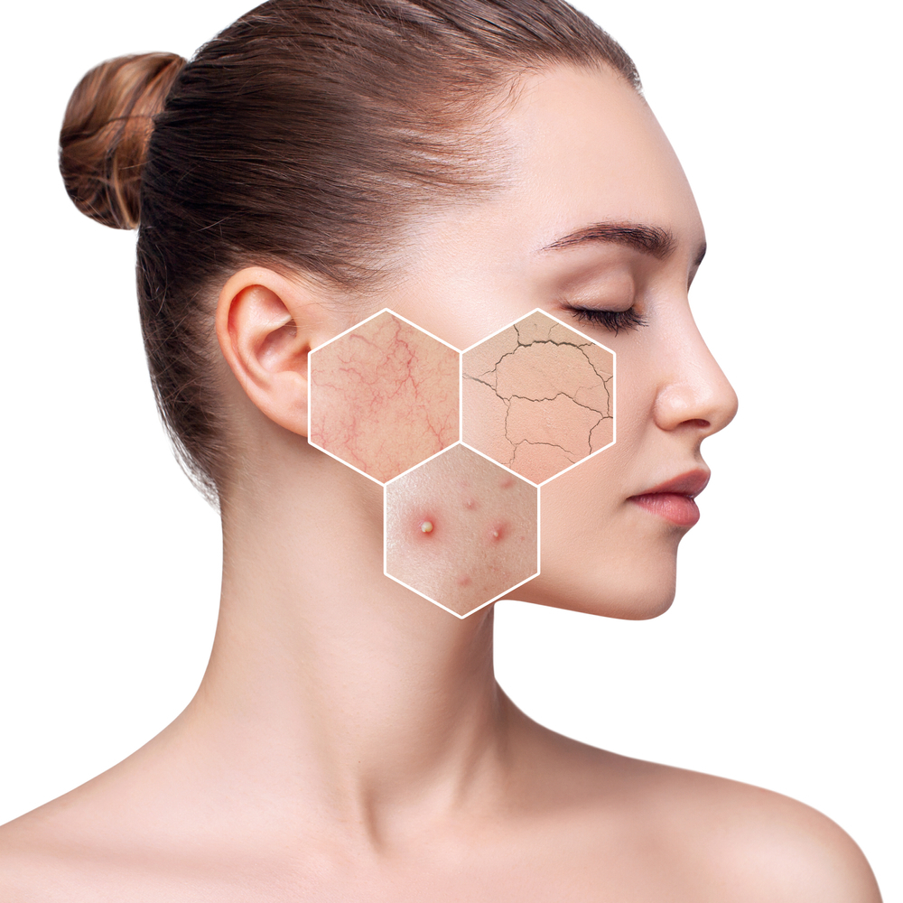 Areas for correction laser facial