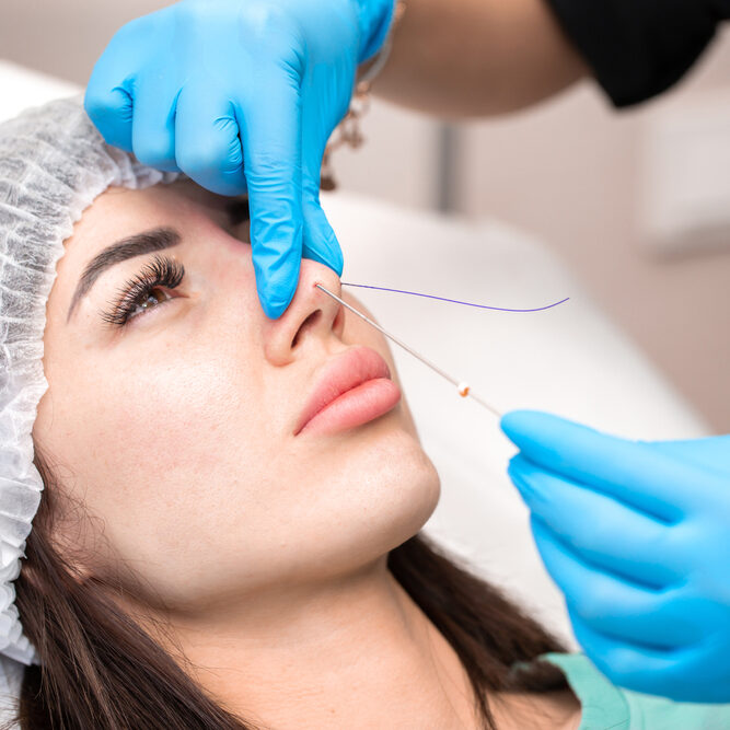 THREADS RHINOPLASTY WORKS