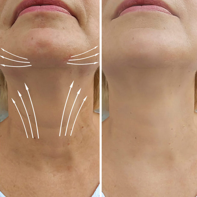 Thread neck lift before and After