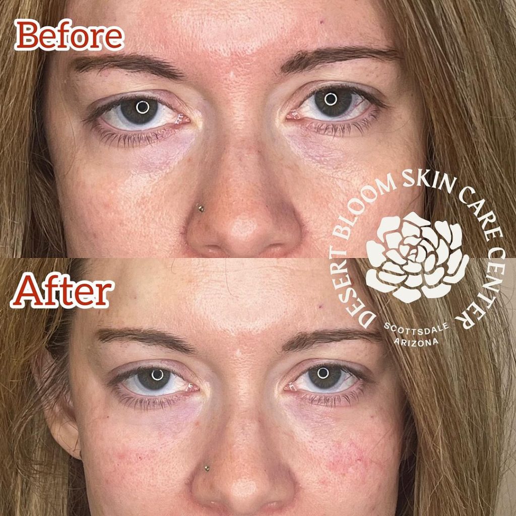 Before & after | Under eye refresh with dermal filler | full face