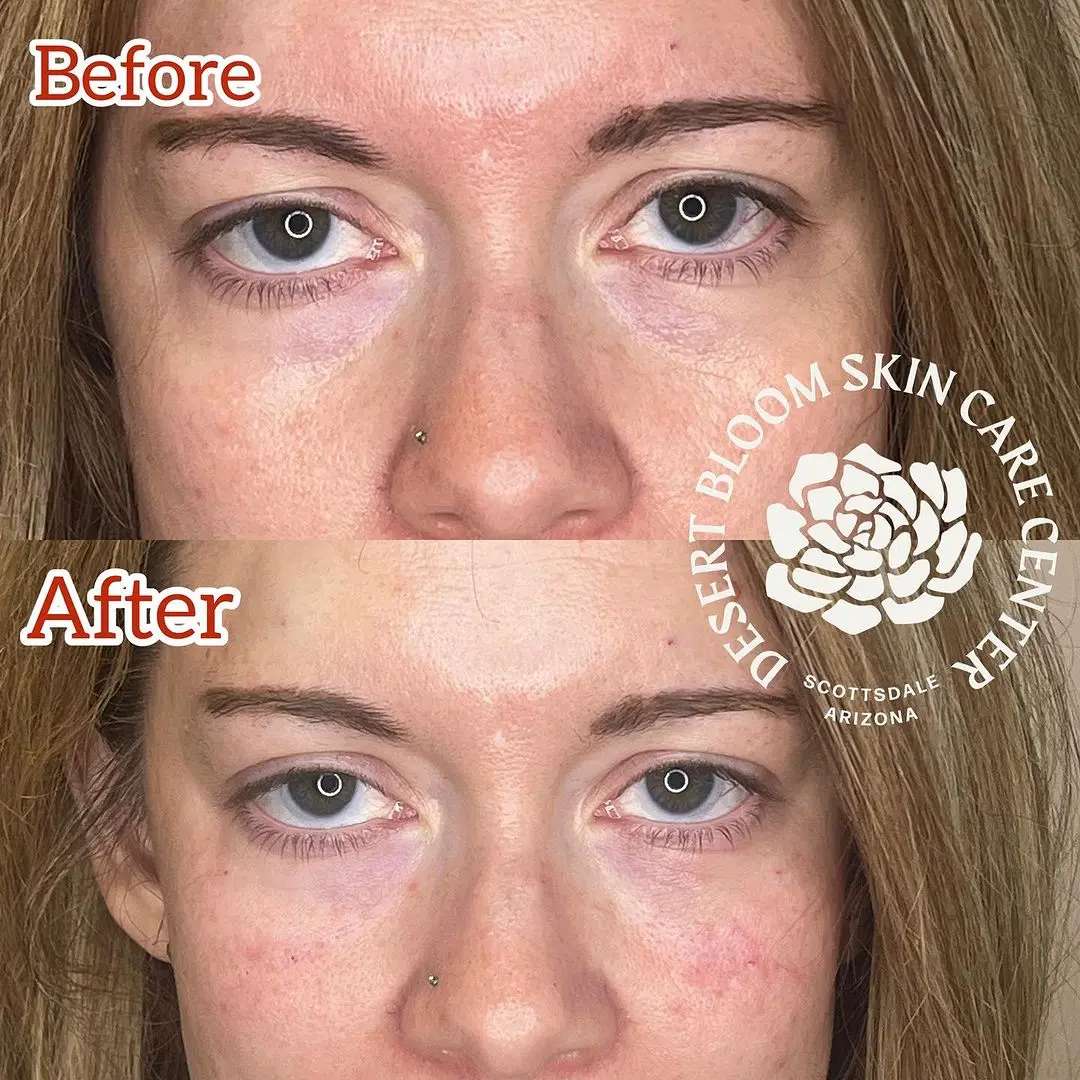 Bruising Tear Trough Fillers near me Scottsdale, AZ