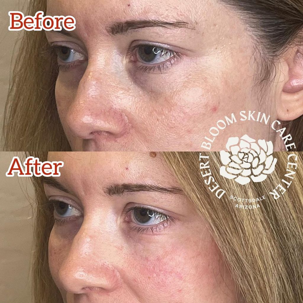 Before & after | Under eye refresh with dermal filler | profile 3-4 left