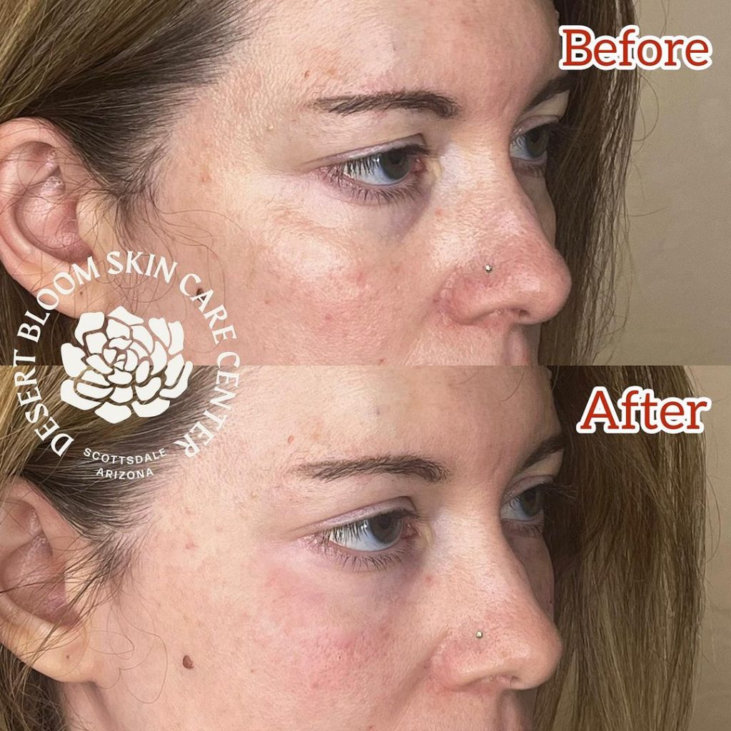 Before & after | Under eye refresh with dermal filler | profile 3-4 right