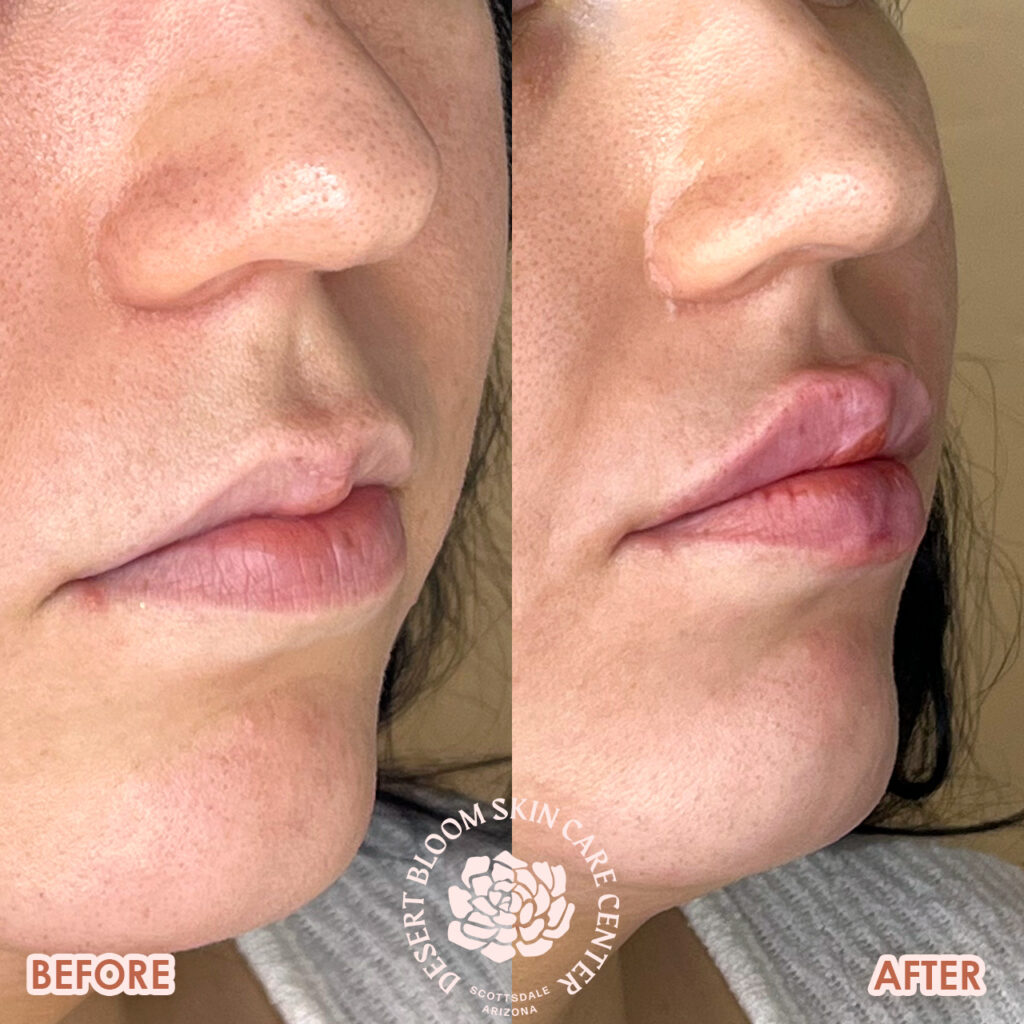 lip filler before and after