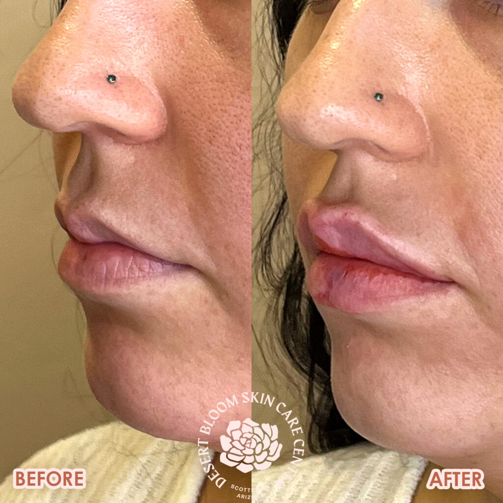 lip filler before and after