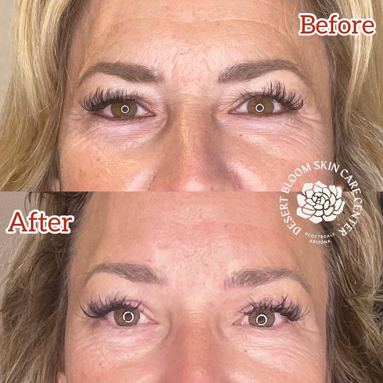 before and after PDO THREAD BROW LIFT full face photo