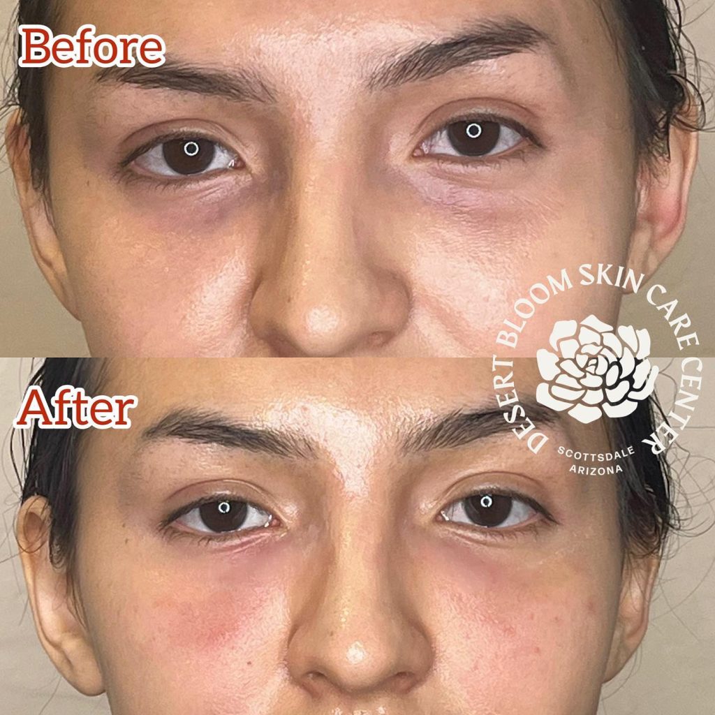 Before & after | Tear trough correction | full face