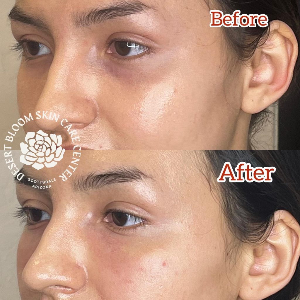 Before & after | Tear trough correction | right profile