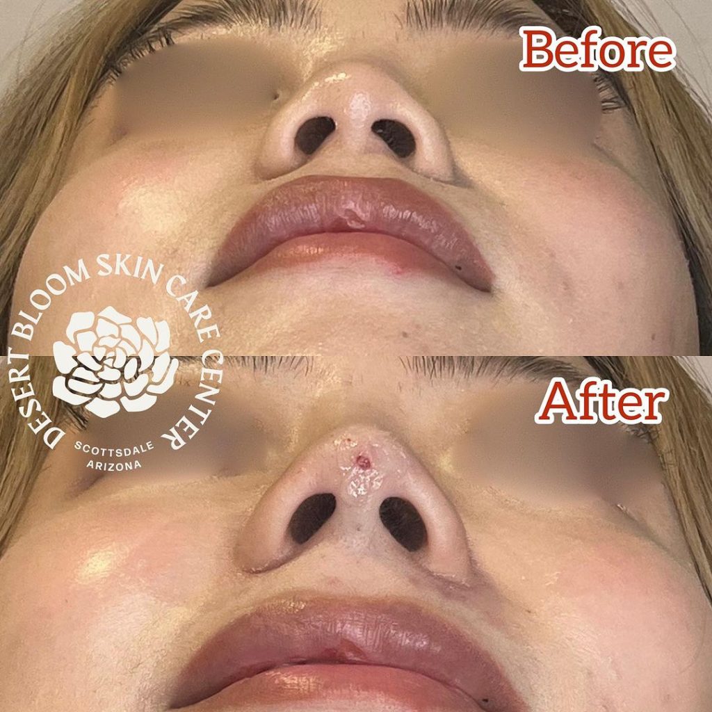 before &after | Non surgical rhinoplasty with PDO threads | nose tip