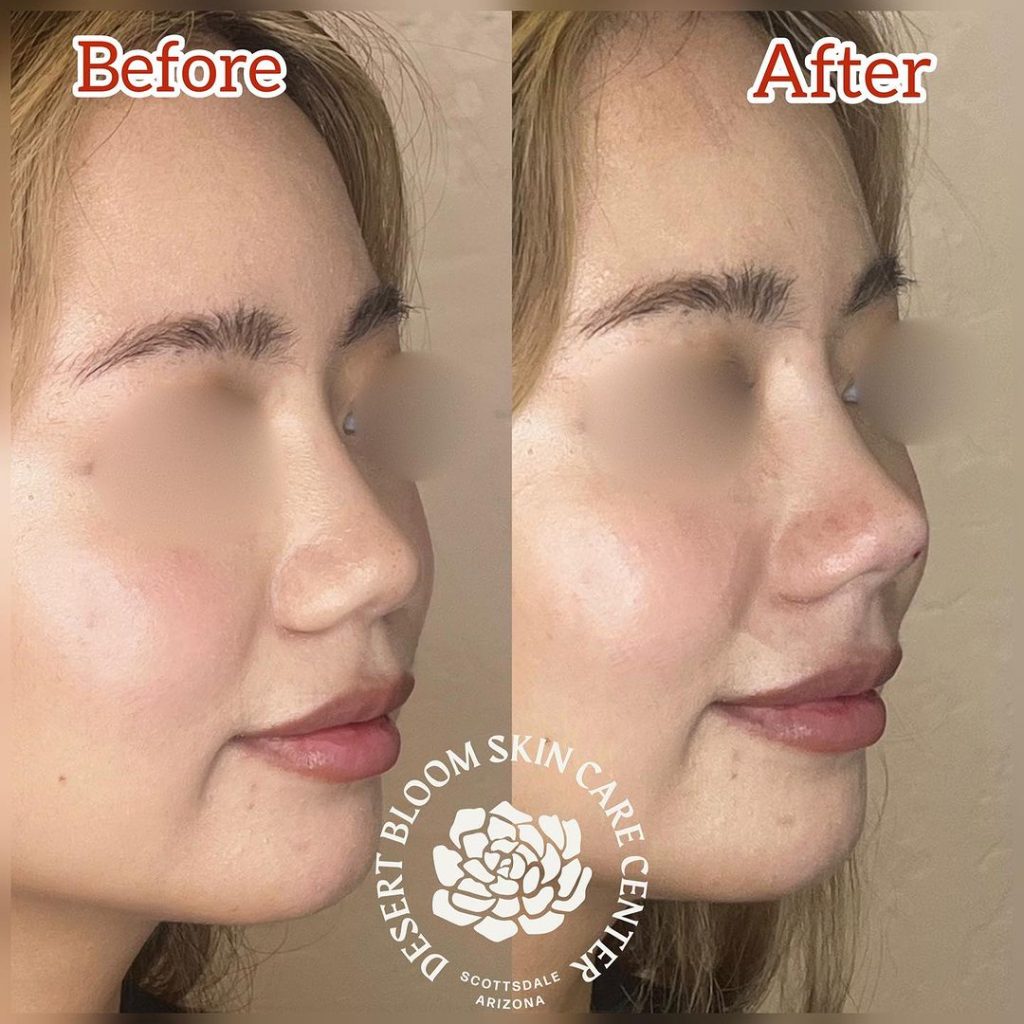before & after | Non surgical rhinoplasty with PDO threads | profile 3-4 right