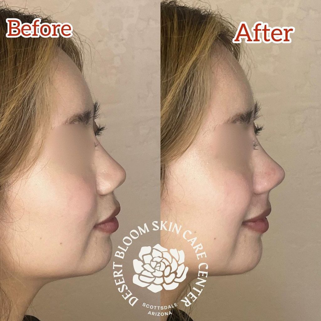 before & after | Non surgical rhinoplasty with PDO threads | profile right