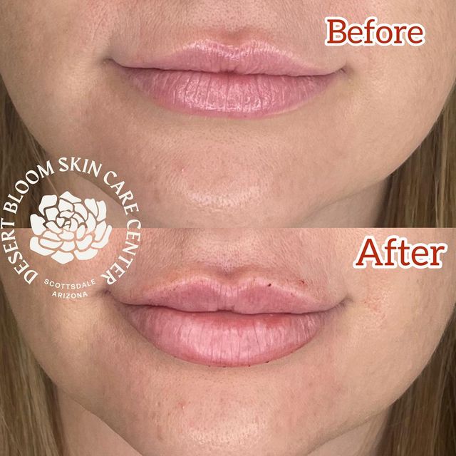 before & after | Revanesse Versa | lip | full face