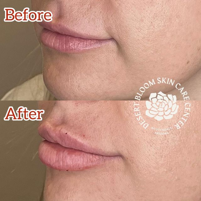 before & after | Revanesse Versa | lip | profile left