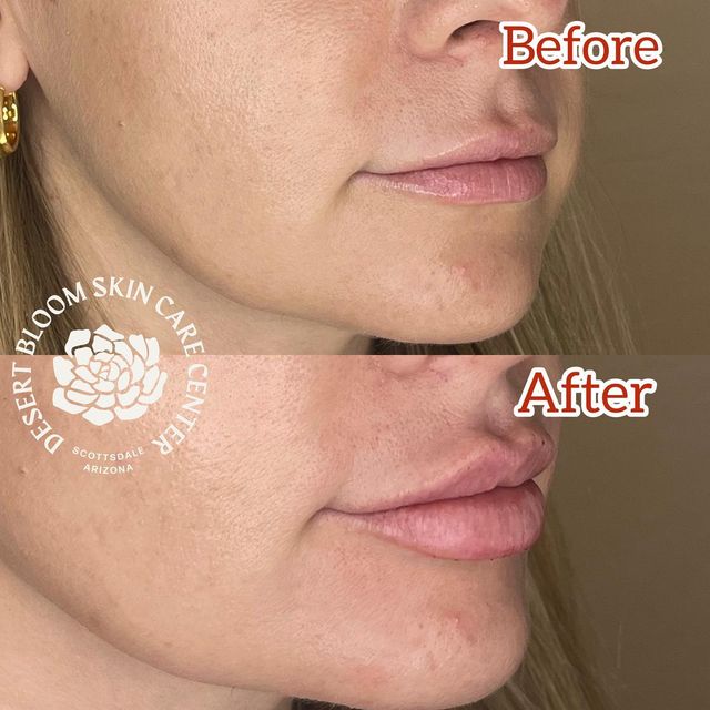 before & after | Revanesse Versa | lip | profile right