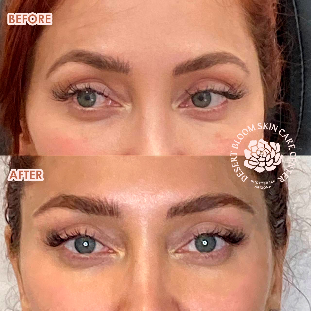 before and after PDO THREAD BROW LIFT full face photo