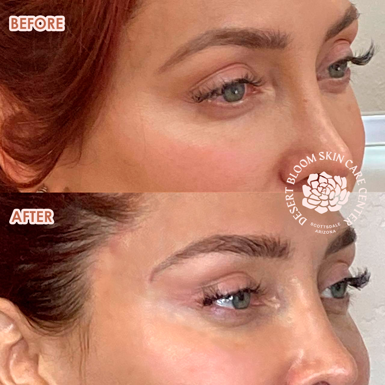 before and after PDO THREAD BROW LIFT left face photo
