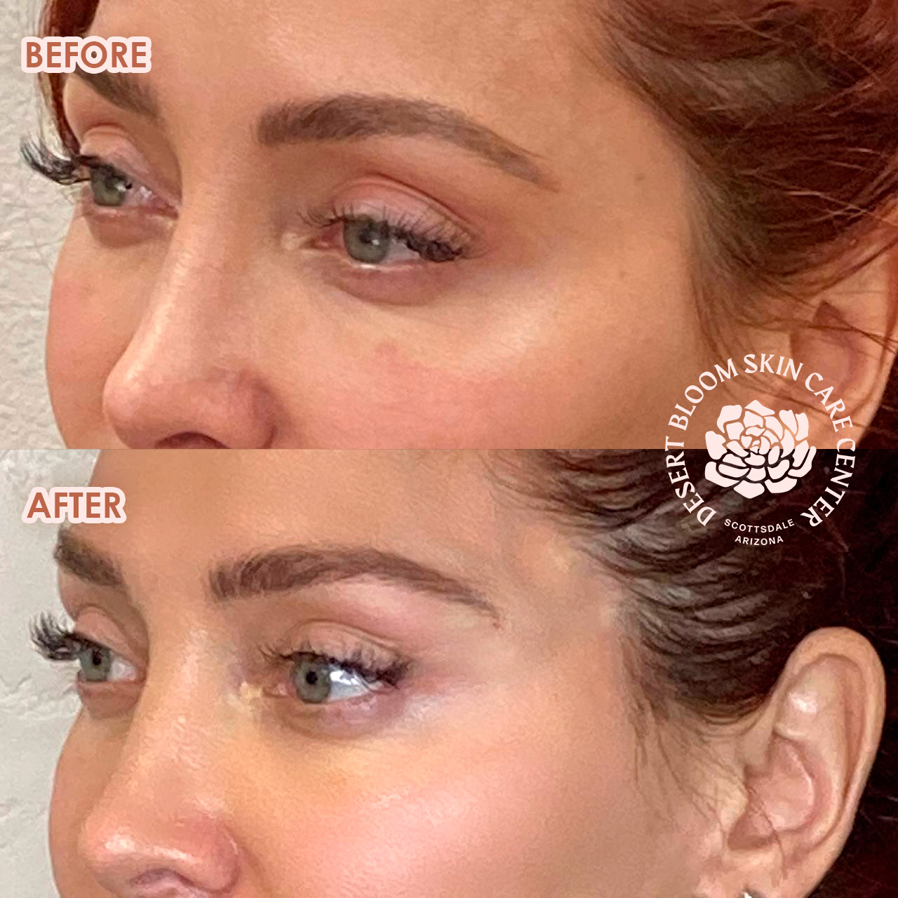 before and after PDO THREAD BROW LIFT right face photo