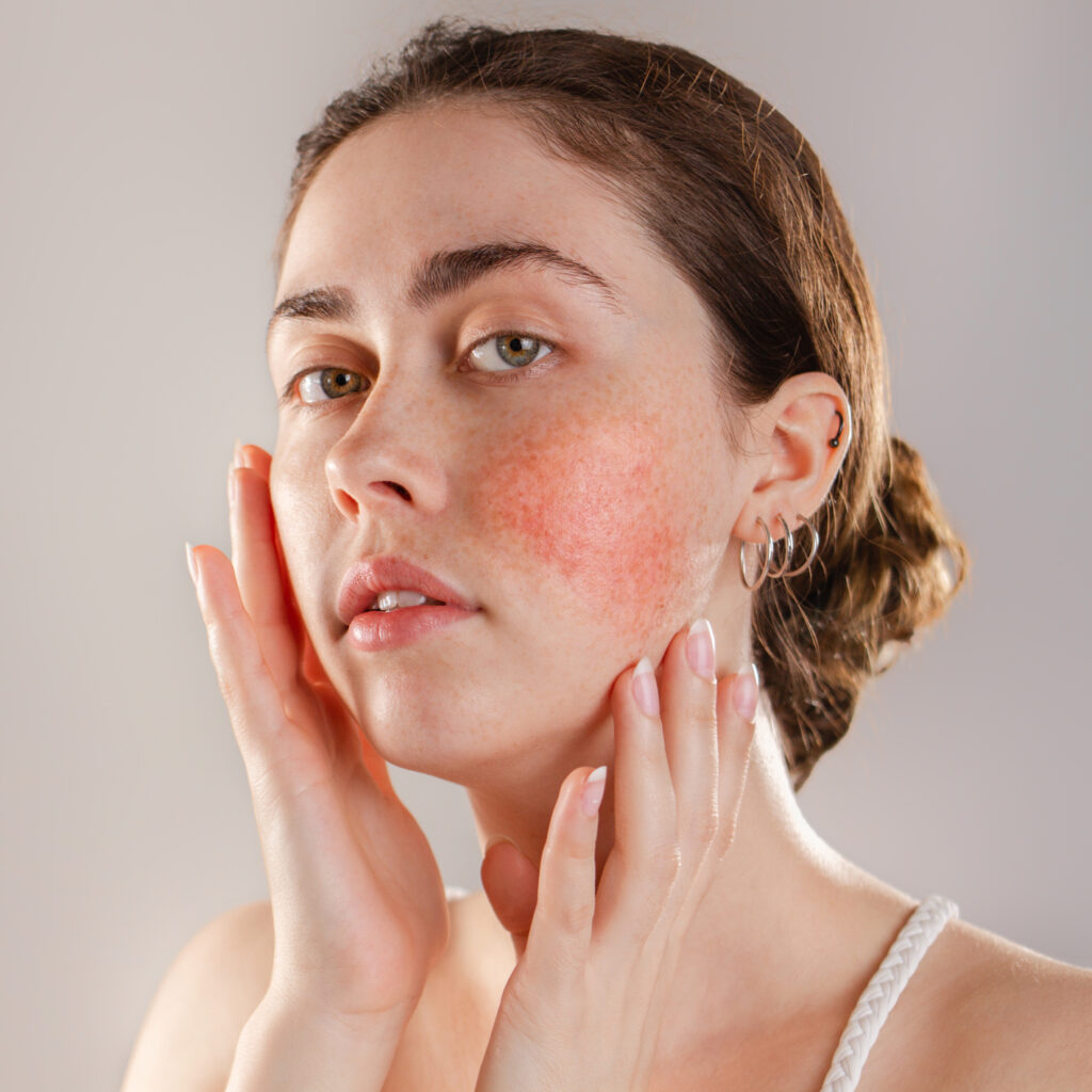 Vein and redness removal can help Rosacea