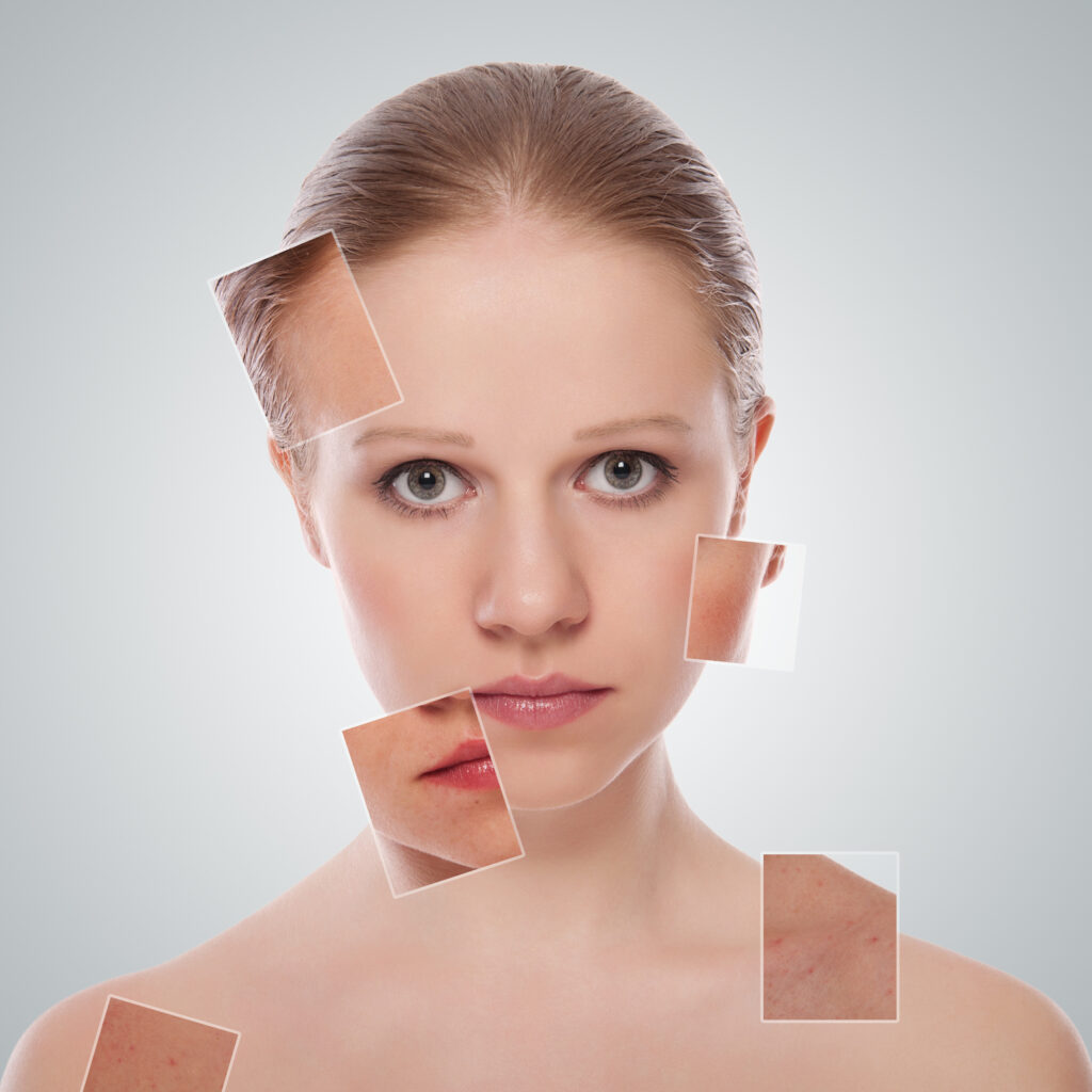 Areas for correction erbium laser resurfacing