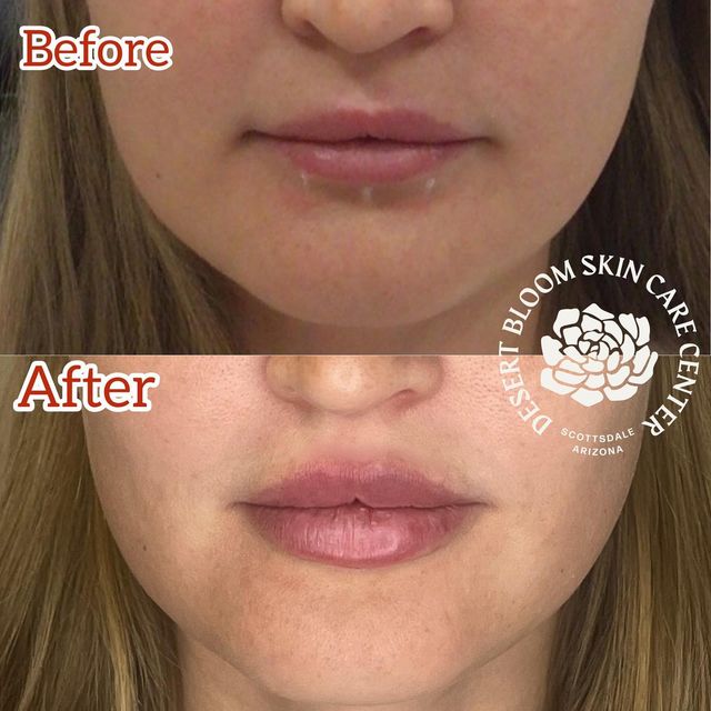 before-after | lips with Revanesse Versa dermal filler | full face