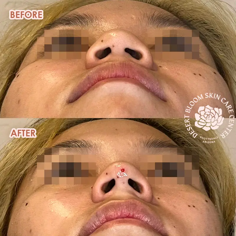 Tip projection for Asian noses Photo