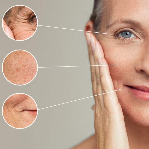 wrinkle treatment with RF microneedling