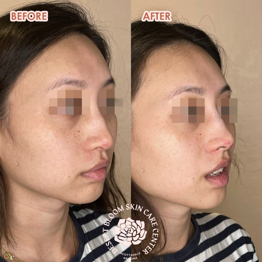 Lifting tip of the nose with PDO threads for Women | Before & After | Front Left face Photo
