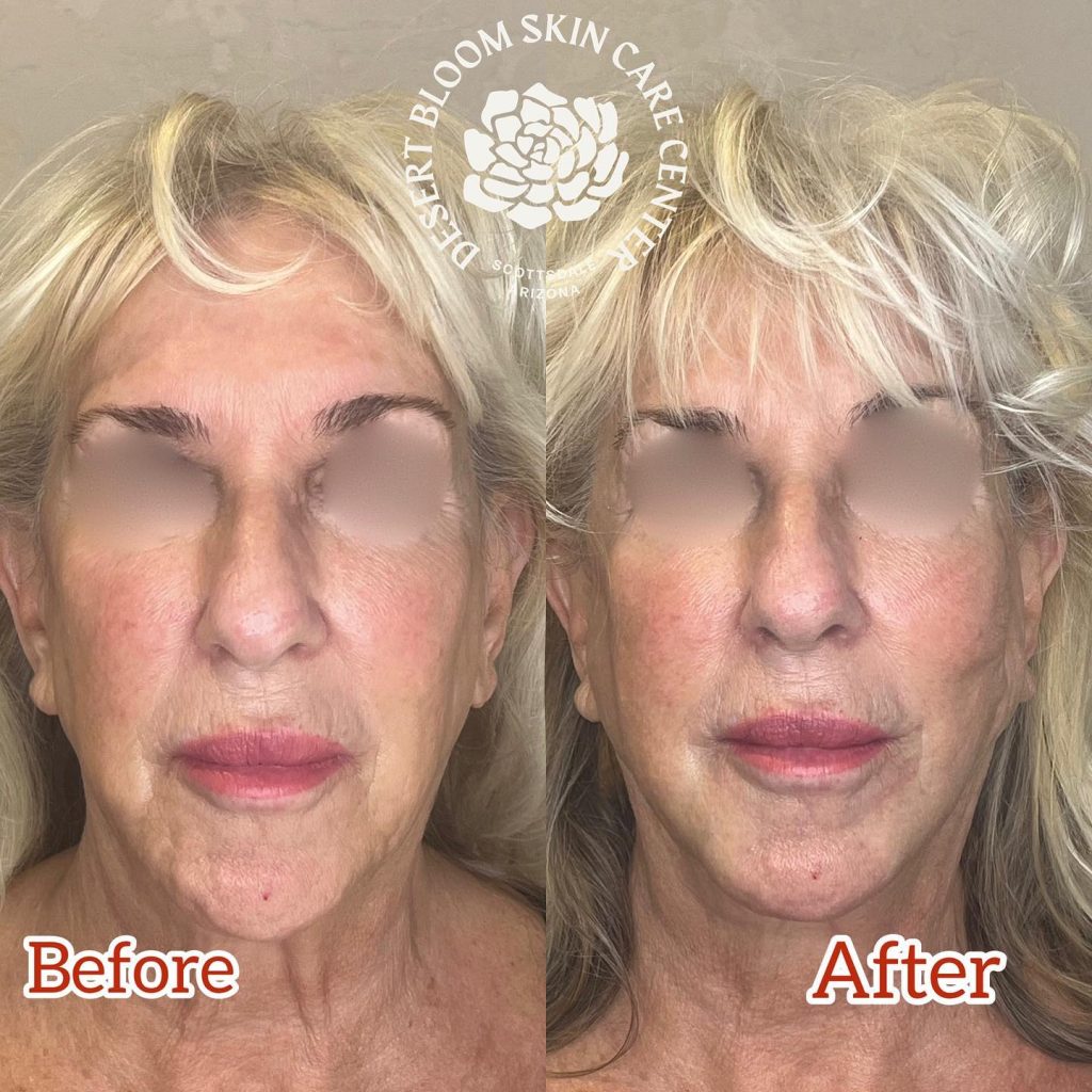 Before & after | Full face rejuvenation and lift with PDO barbed threads using @pdomax | Full face