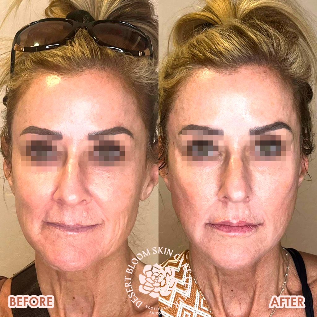 before & after | PDO-thread-lift | full-face