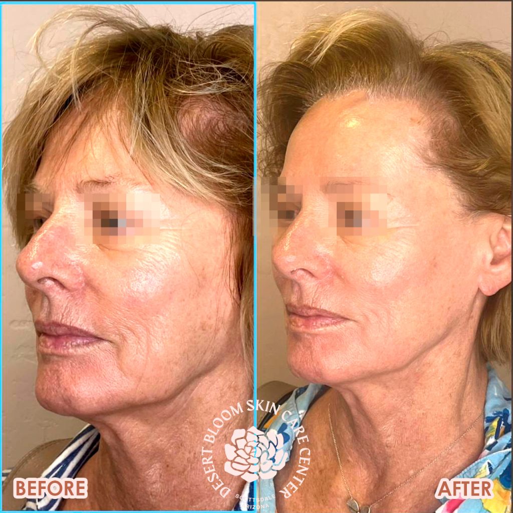 before & after | PDO-thread-lift | mid-face | profile-left